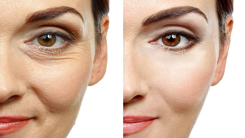 sculptra-injections